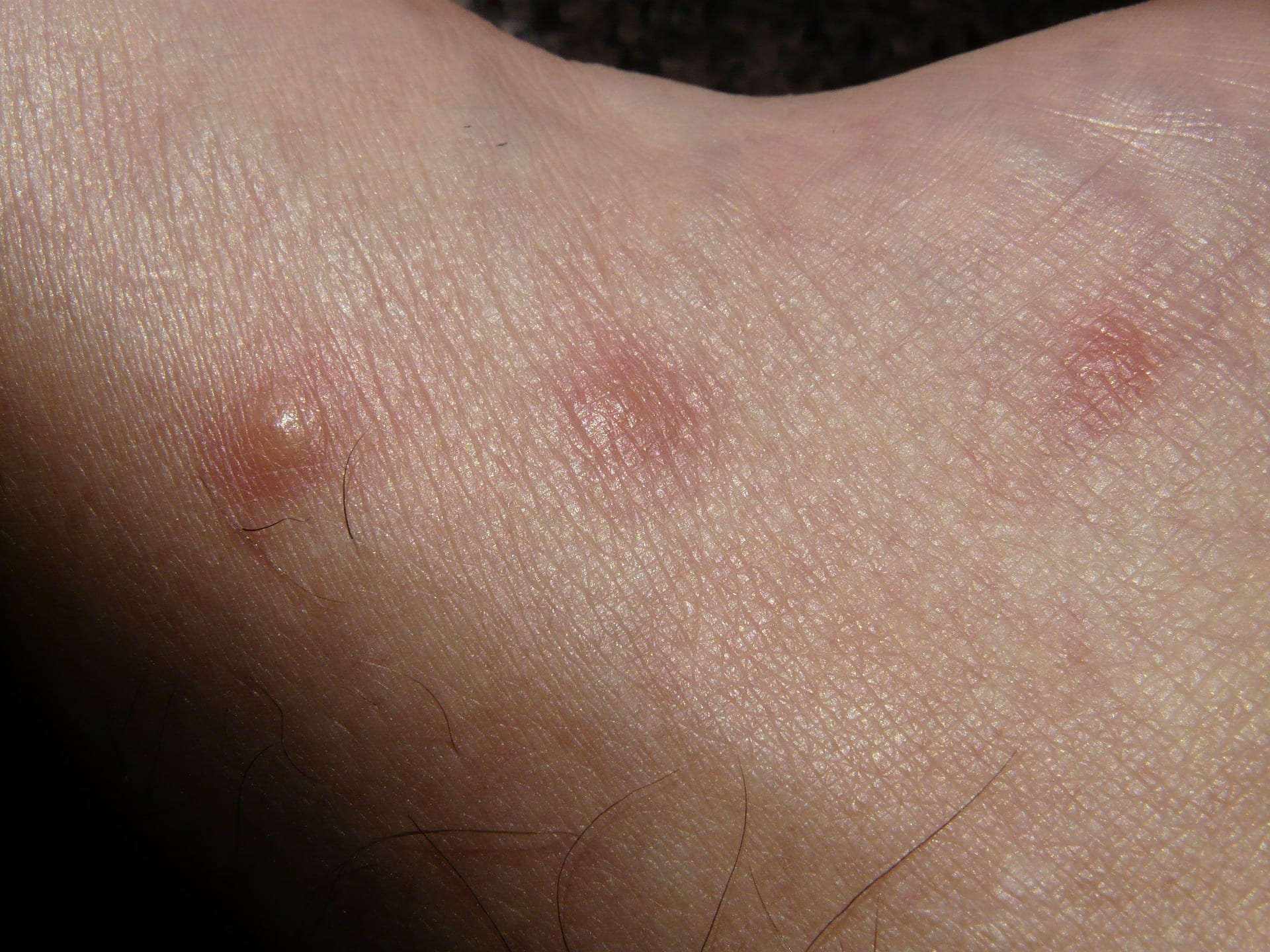 infected mosquito bite blister